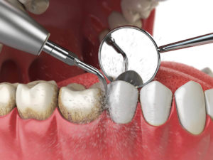 A close-up illustration of a dental cleaning procedure. A dental scaler is removing plaque and tartar from the surface of teeth, while a dental mirror is used to reflect the area being cleaned. The image shows the removal of debris and buildup from the teeth, highlighting the importance of dental hygiene and professional cleaning.